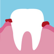 Icon Gingivitis