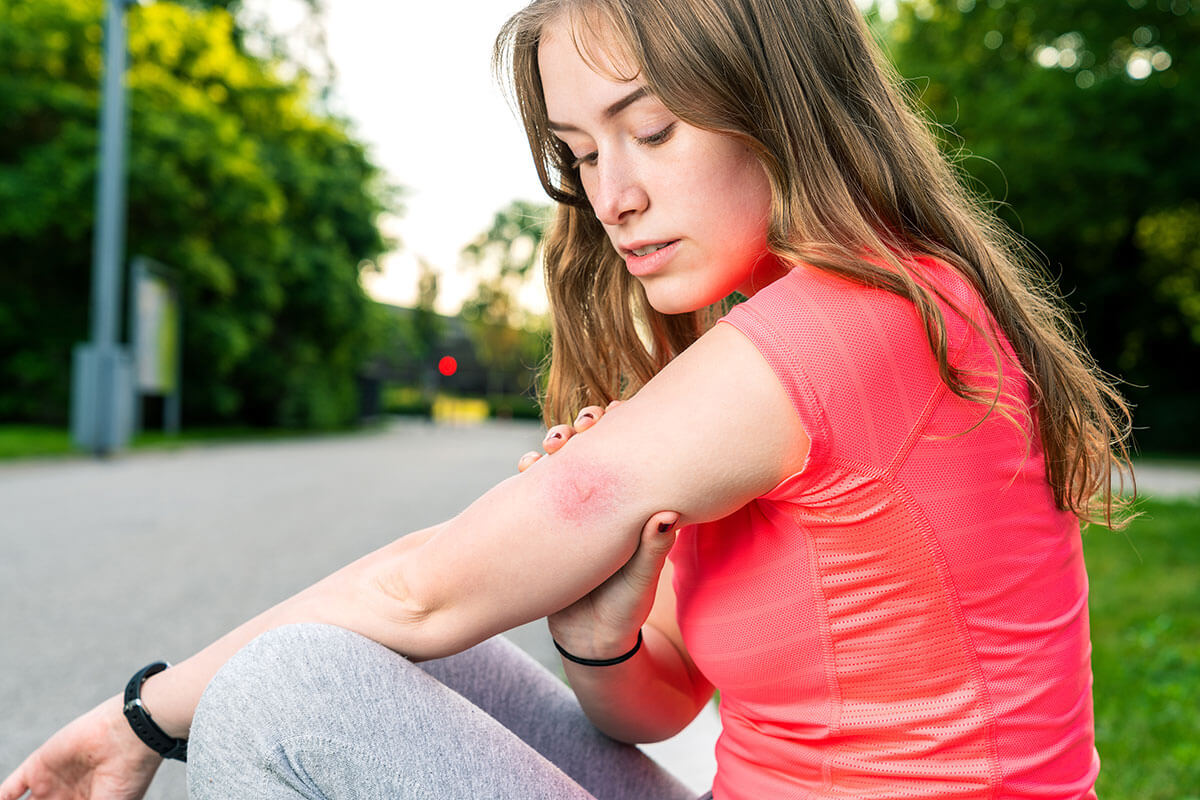 Person mit Insektenstich am Arm